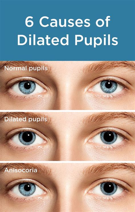 Can anxiety cause dilated pupils?