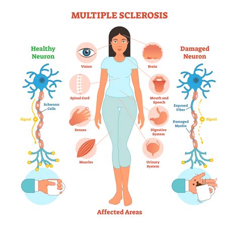 Can anxiety look like MS?