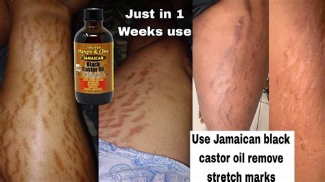 Can any oil remove stretch marks?