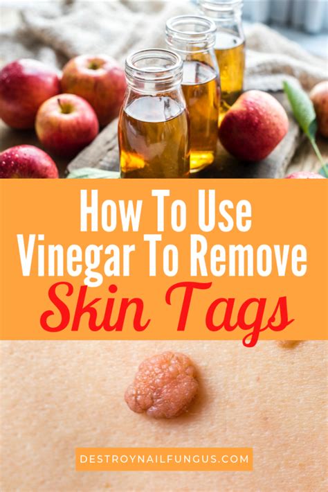 Can any vinegar remove skin tags?