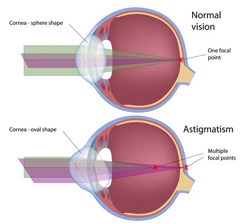 Can astigmatism go away?
