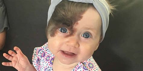 Can babies inherit birthmarks?