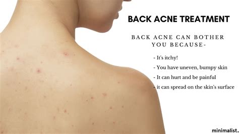 Can back acne spread to face?