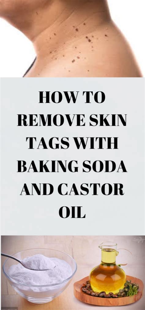 Can baking powder remove skin tags?