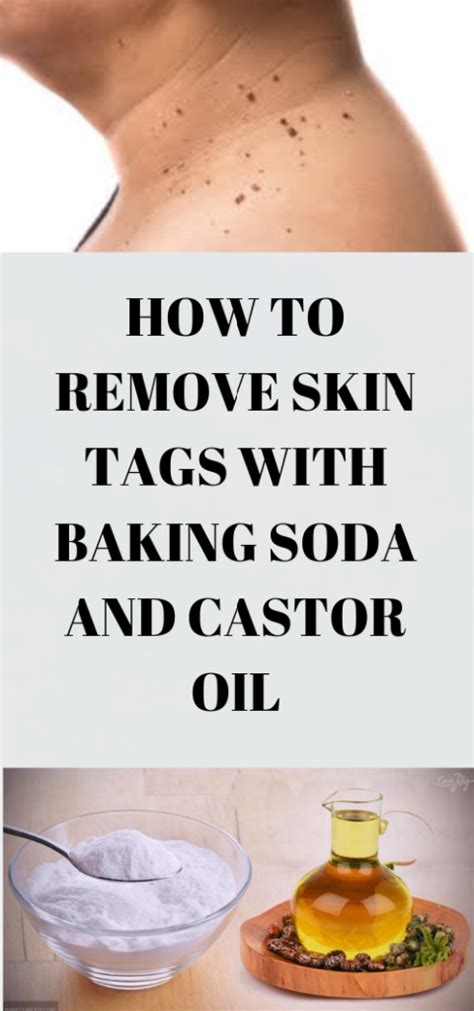 Can baking soda remove skin tags?