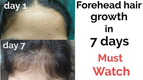 Can bald forehead hair grow?