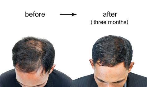 Can balding be reversed?