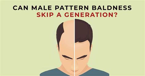 Can baldness skip a generation?