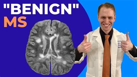 Can benign MS stay benign?