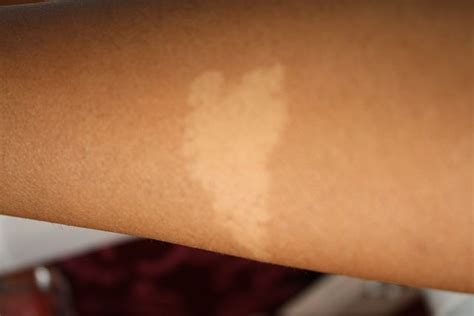 Can birthmarks be white?