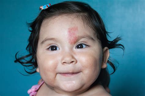 Can birthmarks skip a generation?