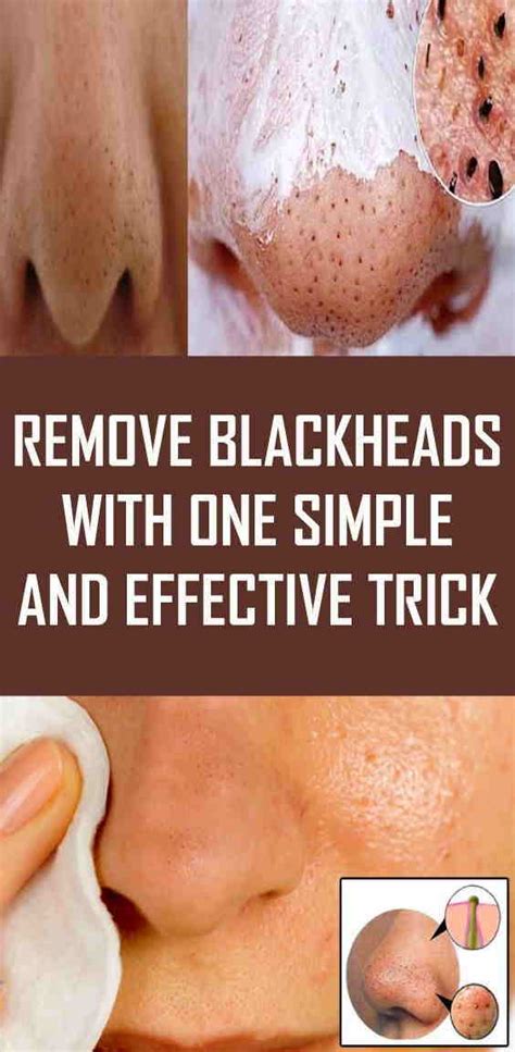 Can blackheads be removed naturally?