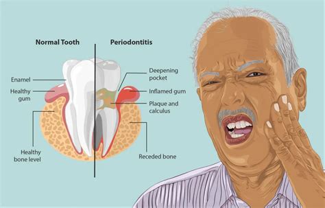 Can bone loss from periodontitis be stopped?