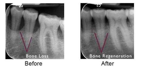 Can bone regenerate after periodontal disease?