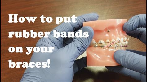 Can braces rubber bands snap?