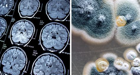 Can brain damage from mold be reversed?