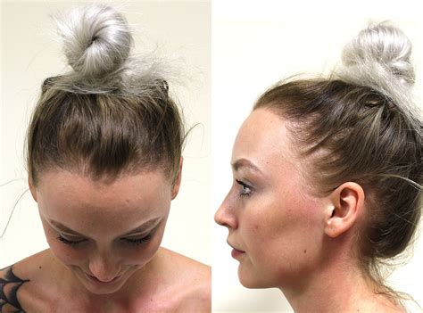 Can buns cause alopecia?