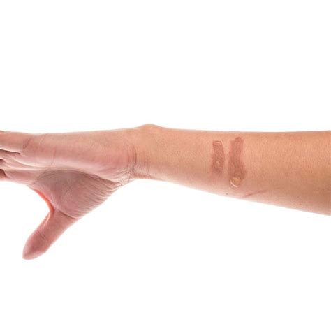 Can burn scars be permanent?
