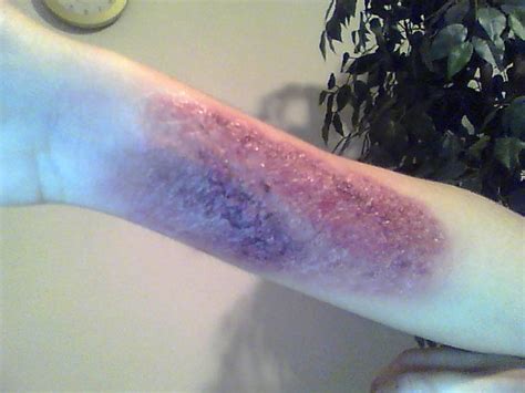 Can burn scars be purple?