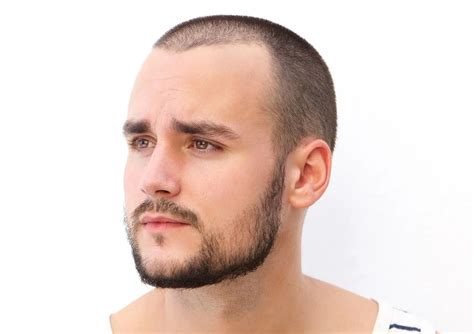 Can buzz cut fix hairline?