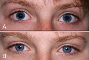 Can caffeine cause small pupils?