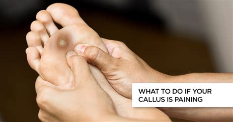 Can calluses stay for years?