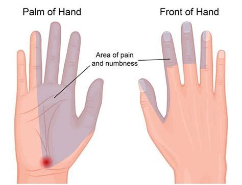 Can carpal tunnel cause permanent numbness in fingers?