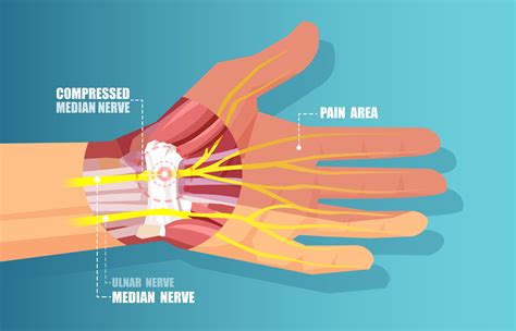 Can carpal tunnel damage your hand?