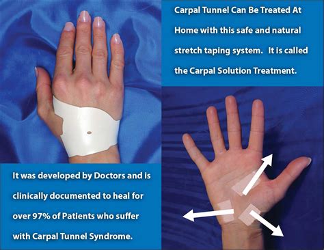 Can carpal tunnel heal on its own?