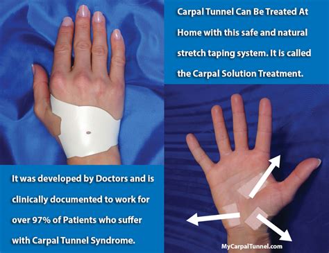 Can carpal tunnel repair itself?