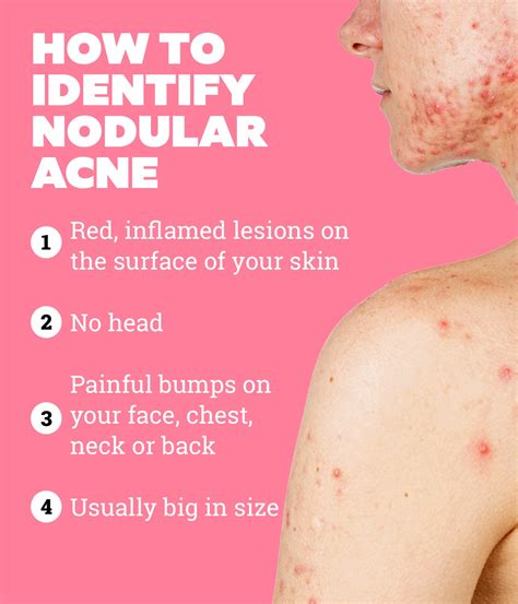 Can chest and back acne be hormonal?