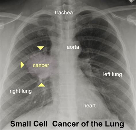 Can chest xray tell if you smoke?