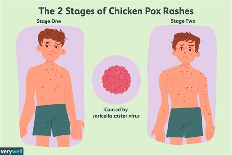 Can chickenpox be spread through indirect contact?