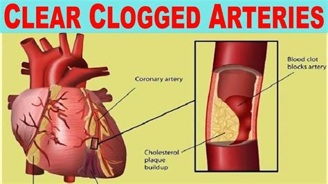 Can cinnamon remove plaque from arteries?
