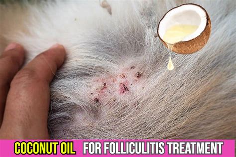 Can coconut oil cause folliculitis?