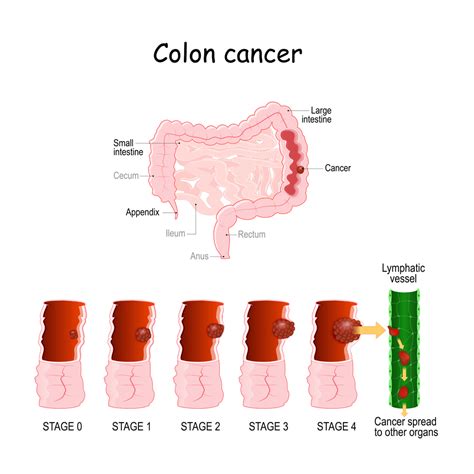 Can colon cancer be fast growing?