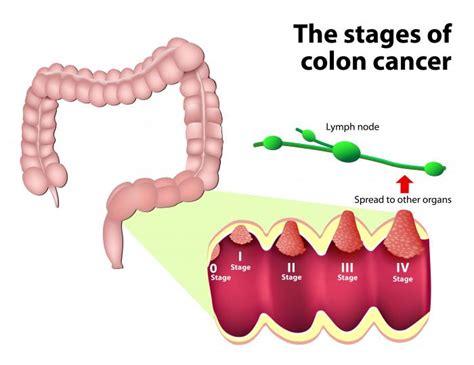 Can colon cancer develop in 2 years?