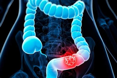Can colon cancer develop in less than 10 years?