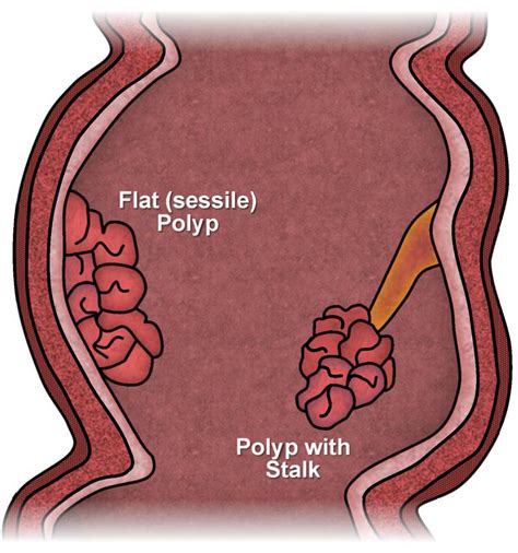 Can colon polyps grow in a year?