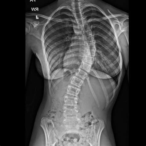 Can contortion cause scoliosis?