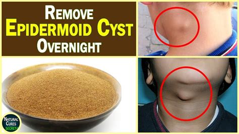 Can cysts disappear overnight?