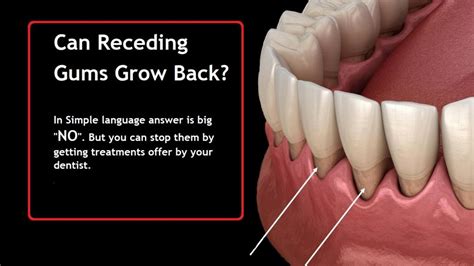 Can damaged gums grow back?
