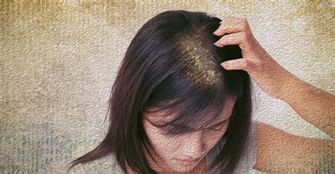 Can dandruff cause hair fall?