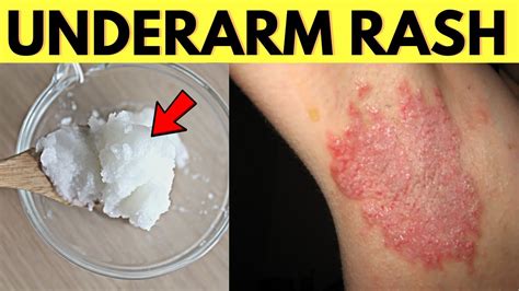 Can deodorant cause skin tags?