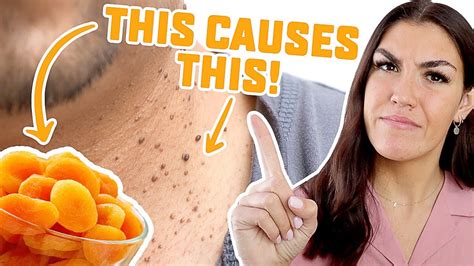 Can diet reduce skin tags?