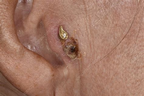 Can earring holes get infected after years?