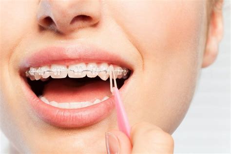 Can elastics loosen teeth?