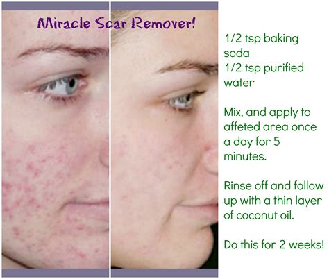 Can exfoliating remove scars?