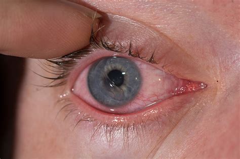 Can eye cornea heal?