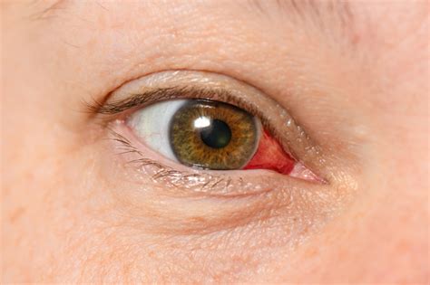 Can eye injury heal on its own?